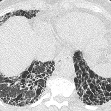 OSIC Pulmonary Fibrosis Progression Dataset - Papersgraph