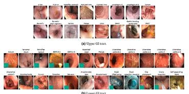 Hyper-Kvasir Dataset